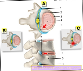 Figura: rigonfiamento del disco intervertebrale