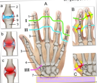 Figure finger osteoarthritis