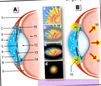 Illustration glaucoma (glaucoma)