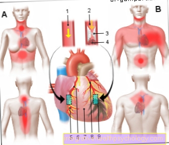 Illustrasjon hjerteinfarkt