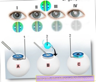 Figure cataract (cataract) surgery
