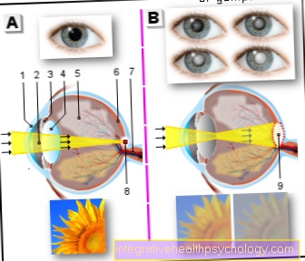 Figure cataracte (cataracte)
