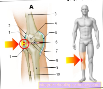 Илюстрация на разкъсването на външната връзка на коляното