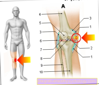 Илустрација сузења лигамента унутрашњег колена