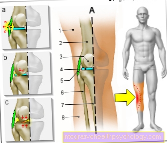 Фигура болка в коляното отвън