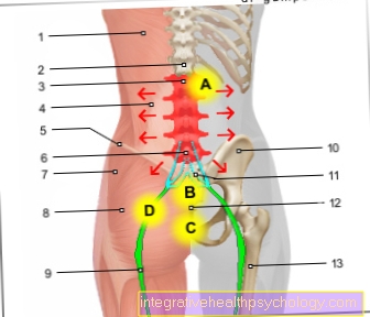 איור תסמונת עמוד השדרה המותני