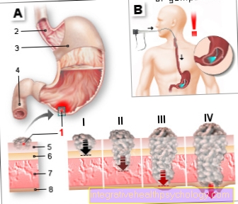 Ilustración de cáncer de estómago