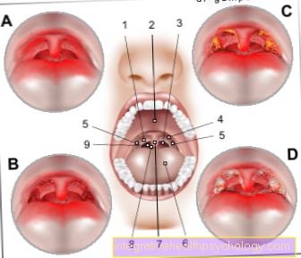 Figure tonsillitis