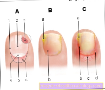 Figure inflammation of the nail bed