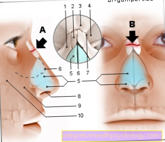 Illustration of a broken nose