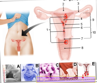 Illustration polyps uterus