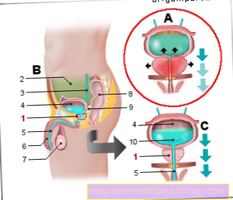 Ilustración de agrandamiento de la próstata