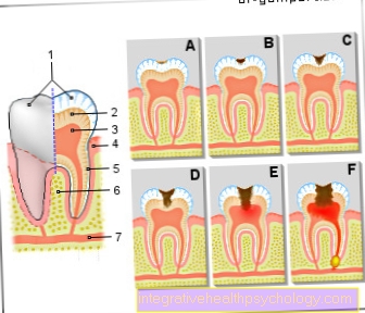 Фигура симптоми от зъбен кариес