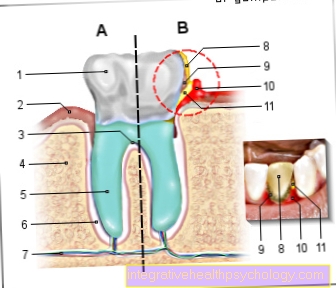 Ilustrace gingivitida
