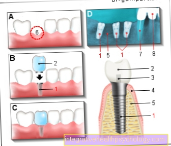 Hambaimplantaadi illustratsioon