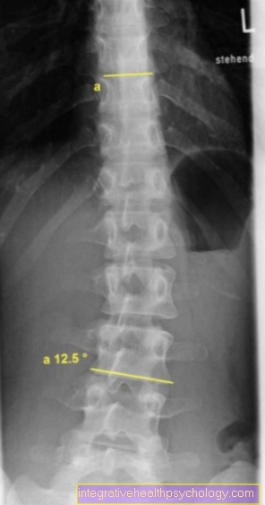 Lumbális gerinc (gerincvelő) röntgenfelvétel skoliozissal