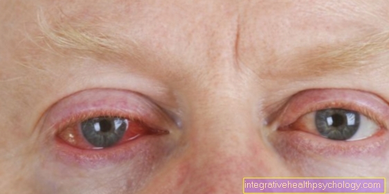 Klamydial infeksjon i øyet