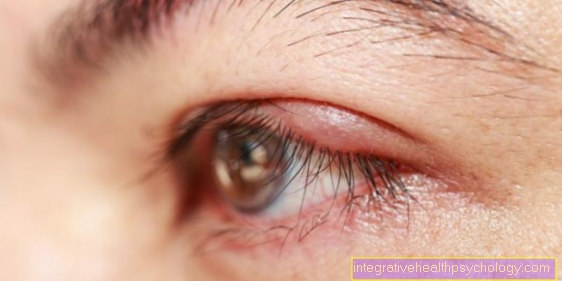 Inflammation of the eyelid