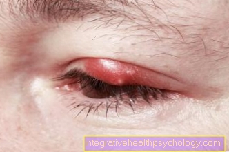 Inflammation av övre ögonlock