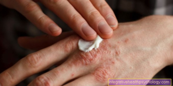 Atópiás dermatitis kezelése