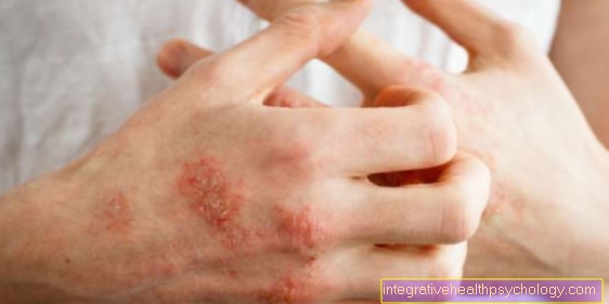 Can you cure neurodermatitis?