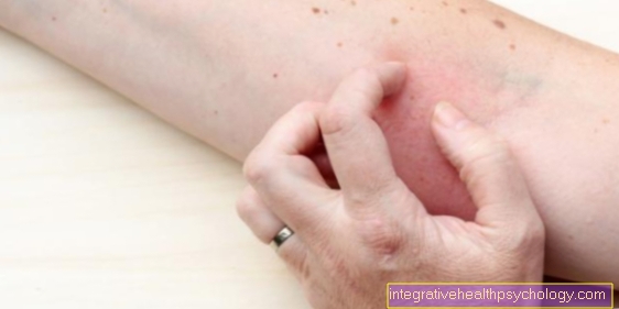 Zwelling na een wespensteek