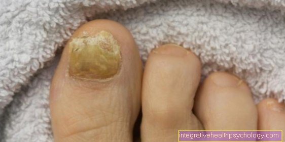 Симптоми грибка нігтів