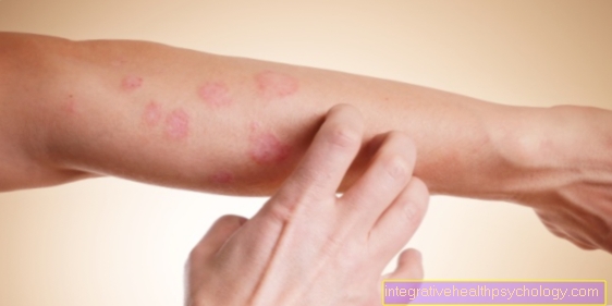 What are the symptoms of scabies?