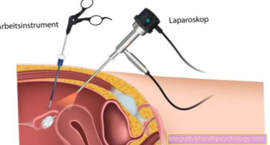 laparoskopi