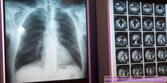 Rentgen hrudníku (rentgen hrudníku)
