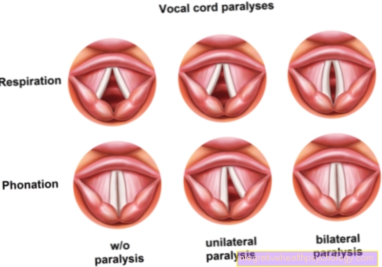 Cordes vocales