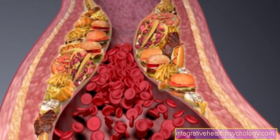 arteriosklerosis