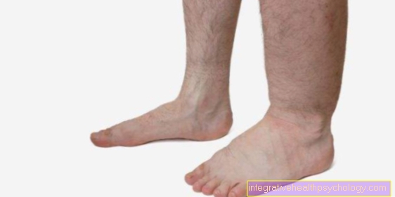 Picioare umflate