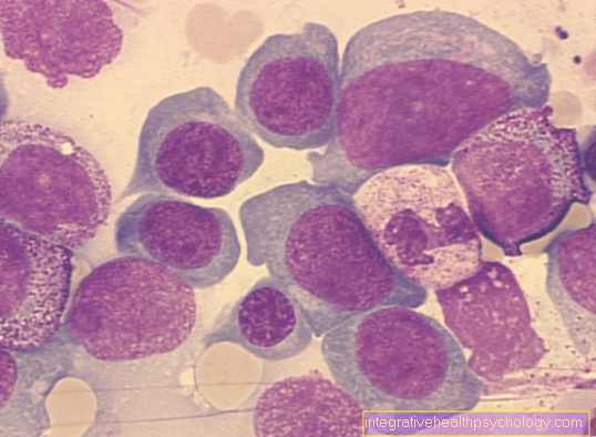 Megaloblastiline aneemia