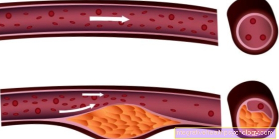 Príznaky aterosklerózy