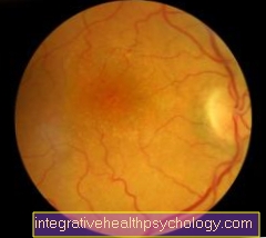 Thrombosis in the eye