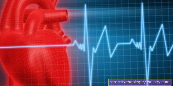 What is the life expectancy with atrial fibrillation?