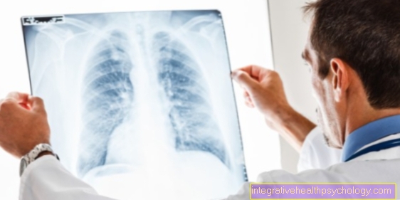 Bagaimana Anda bisa mengenali emboli paru? Apa ciri khasnya?
