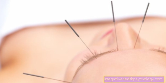 Akupunktura in priprava na porod