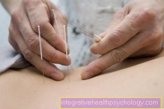 Trigger punkt akupunktur