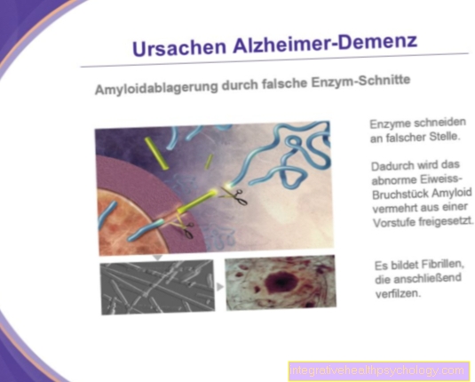 Cause della malattia di Alzheimer