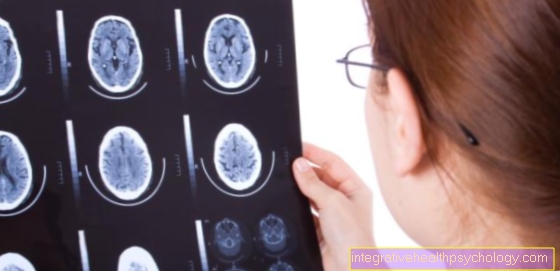 Kateri so vzroki za možgansko krvavitev?