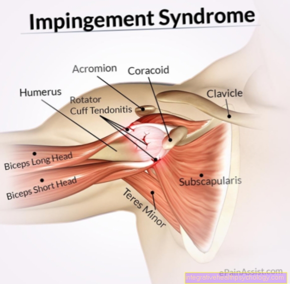 Physical therapy for impingement syndrome