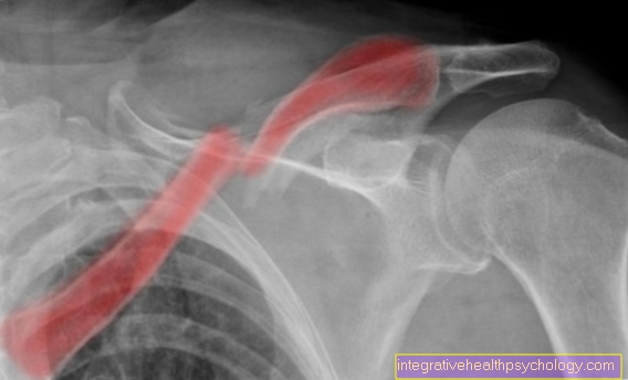 break of collarbone