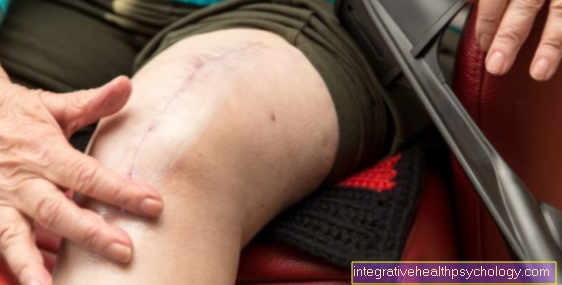 Bolečina s protetičnim kolenom
