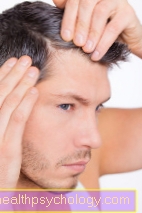 Plaukų persodinimas