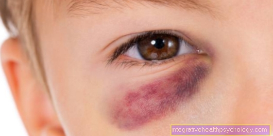 Bruise on the face
