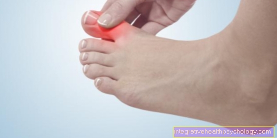 Sprain of a toe