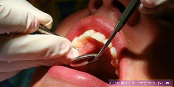 Acute necrotizing ulcerative periodontal disease