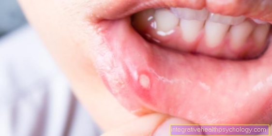Aphthae: cosa aiuta con dolorose vesciche in bocca?